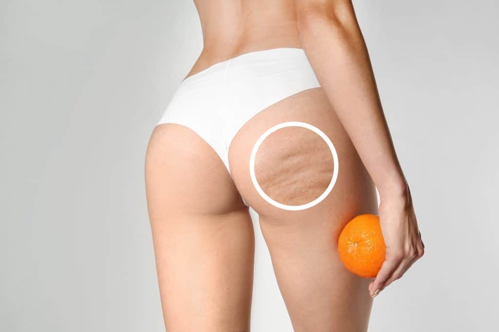 Young,Woman,With,Orange,On,Light,Background.,Problem,Of,Cellulite Bindweefsel Cellulite Behandeling