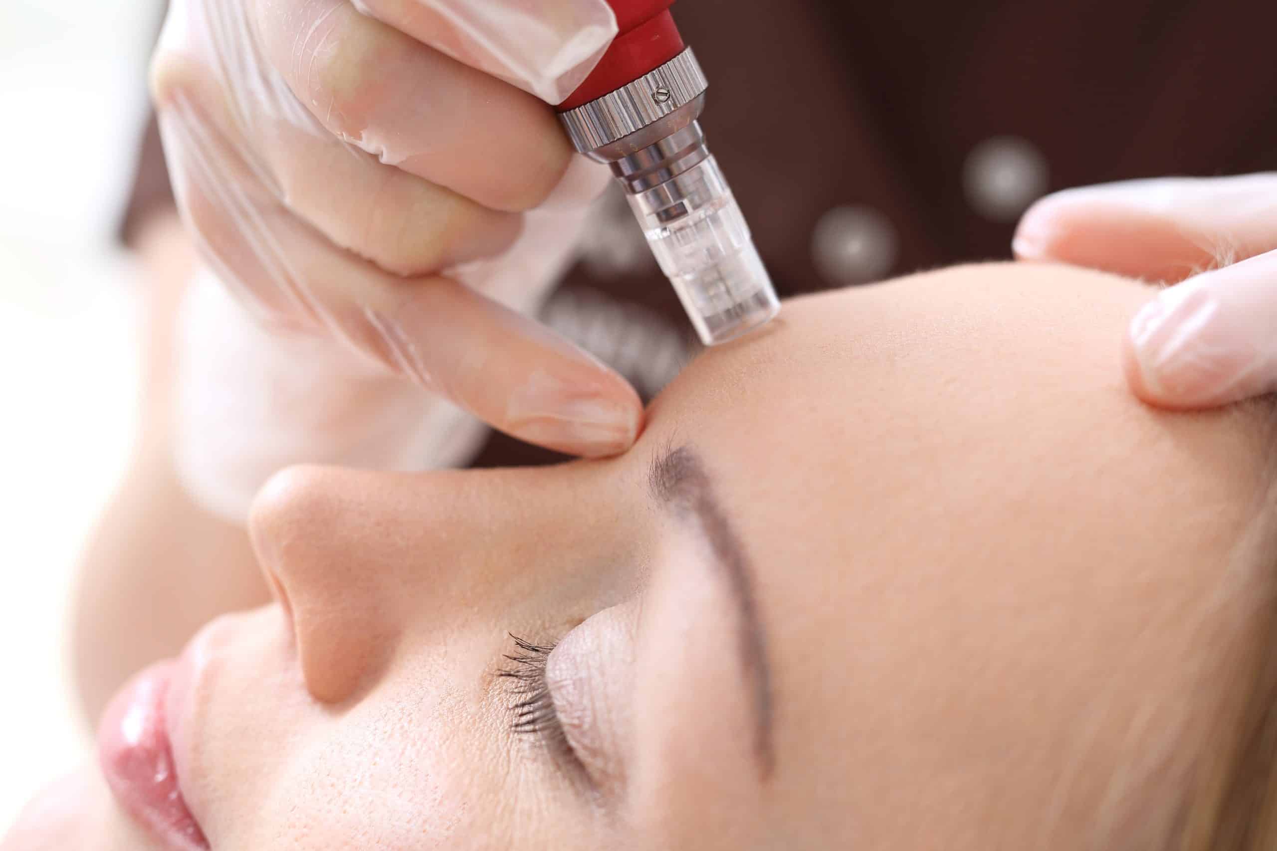 Needle,Mesotherapy,microneedle,Mesotherapy,,Treatment,Woman,At,The,Beautician Microneedling