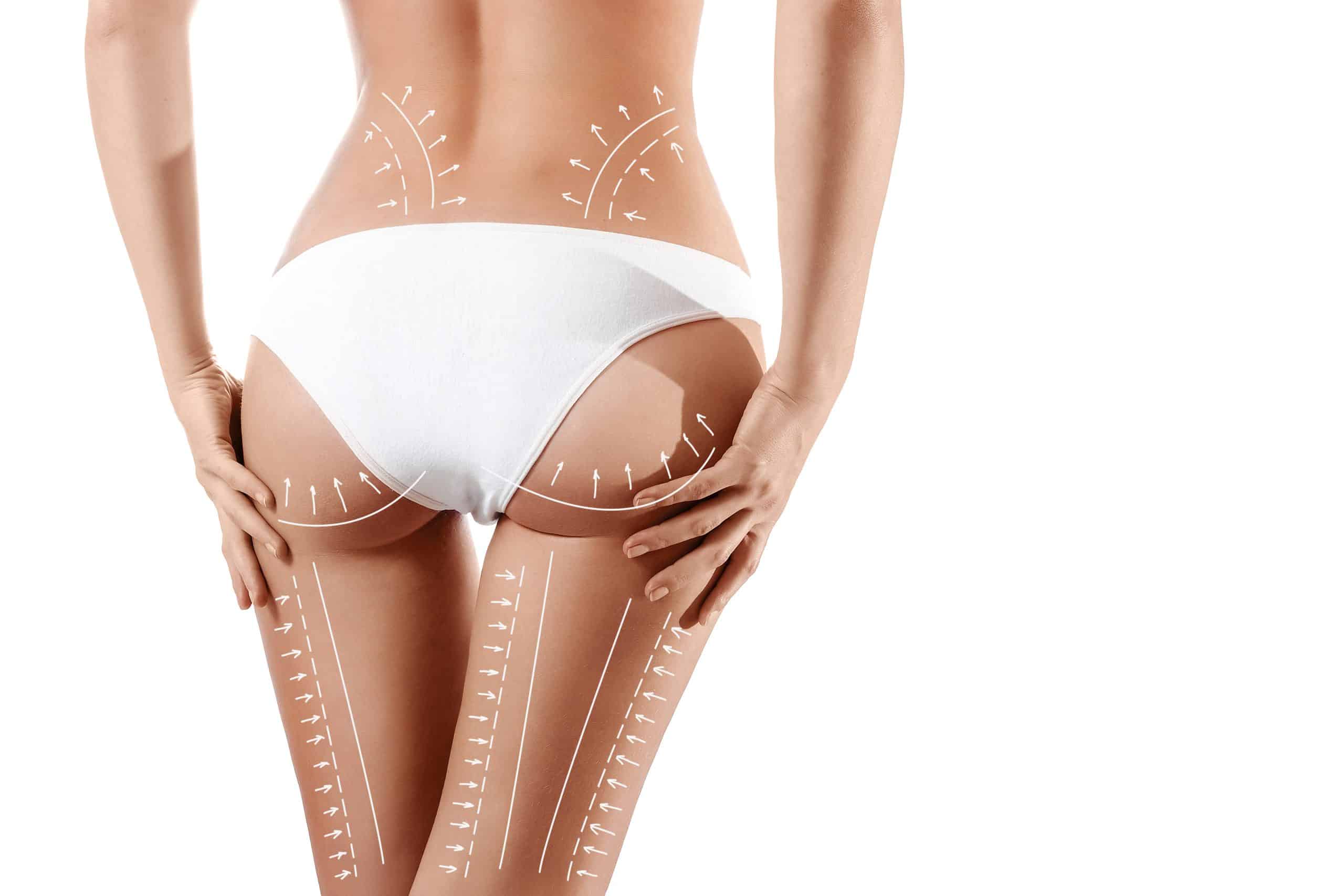 Female,Body,With,Patterned,Lines,And,Arrows,On,It,,Isolated Post Liposuctie Massage
