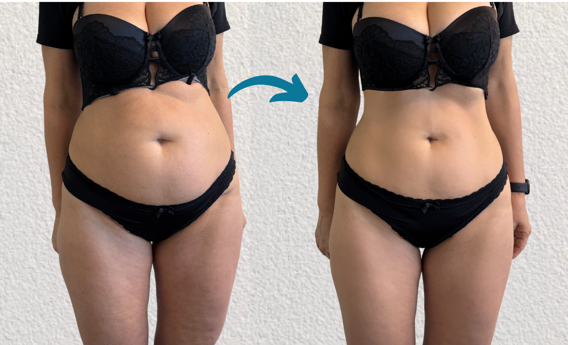 resultaten foto cryolipolise Cryolipolyse