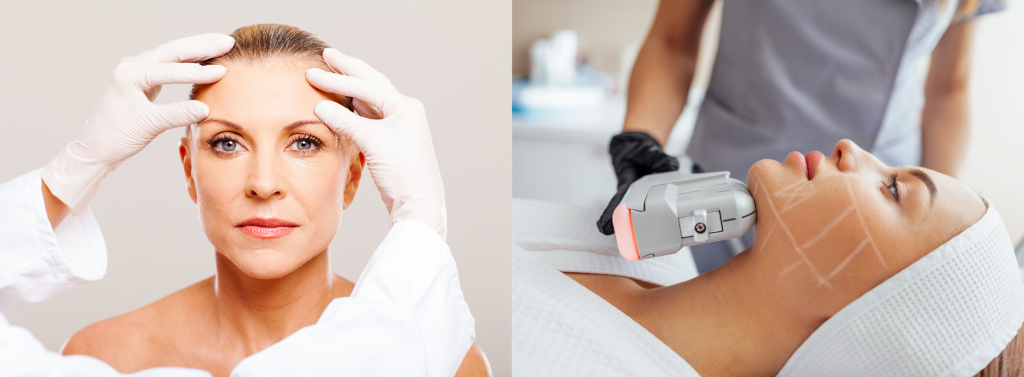 Rimpelreductie met botox en HIFU-behandeling bij vrouw