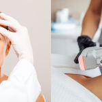 Rimpelreductie met botox en HIFU-behandeling bij vrouw